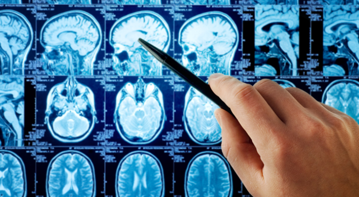 brain cancer mri image